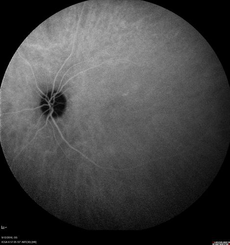Syphilitic Chorioretinitis
Severe outer retinal atrophy and RPE non-geographic atrophy from syphilis.  Vision improved from 20/63 to 20/32 with therapy.  Images look a lot like DUSN.  Patient had several surgeries (vitrectomy for floaters, vitrectomy for macular pucker, Avastin injections and macular laser for edema) prior by other retina specialists prior to being correctly diagnosed and treated.
