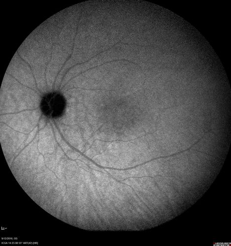 Syphilitic Chorioretinitis
Severe outer retinal atrophy and RPE non-geographic atrophy from syphilis.  Vision improved from 20/63 to 20/32 with therapy.  Images look a lot like DUSN.  Patient had several surgeries (vitrectomy for floaters, vitrectomy for macular pucker, Avastin injections and macular laser for edema) prior by other retina specialists prior to being correctly diagnosed and treated.
