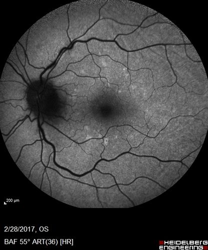 Syphilitic Optic Neuritis - possible Gumma
82 year old woman with vision loss in the left eye 20/32 and positive FTA-ABS (negative RPR). - this may be a gumma
