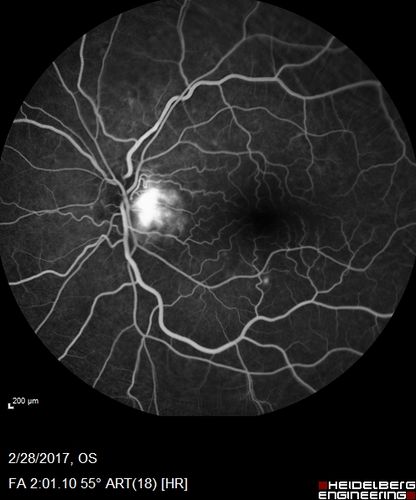 Syphilitic Optic Neuritis - possible Gumma
82 year old woman with vision loss in the left eye 20/32 and positive FTA-ABS (negative RPR). - this may be a gumma
