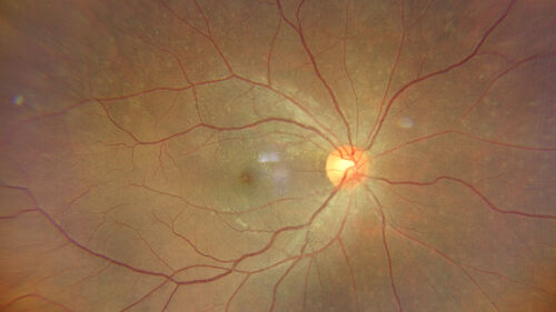 Syphilitic Chorioretinitis
41 year old man with vision loss for five days left eye.  VA 20/32, 20/200
