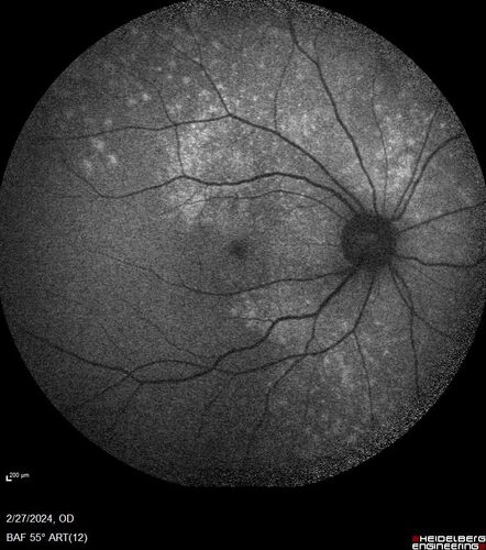 Syphilitic Chorioretinitis
41 year old man with vision loss for five days left eye.  VA 20/32, 20/200

