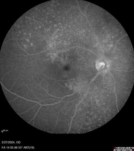 Syphilitic Chorioretinitis
41 year old man with vision loss for five days left eye.  VA 20/32, 20/200
