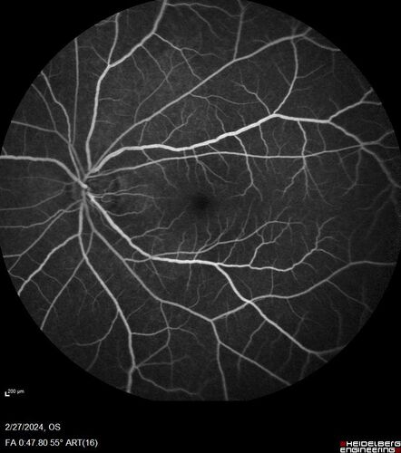 Syphilitic Chorioretinitis
41 year old man with vision loss for five days left eye.  VA 20/32, 20/200
