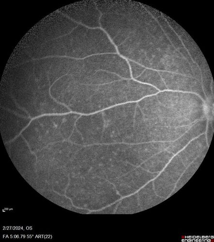 Syphilitic Chorioretinitis
41 year old man with vision loss for five days left eye.  VA 20/32, 20/200
