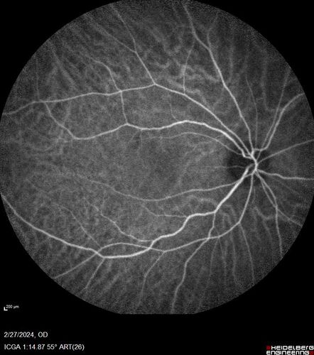 Syphilitic Chorioretinitis
41 year old man with vision loss for five days left eye.  VA 20/32, 20/200
