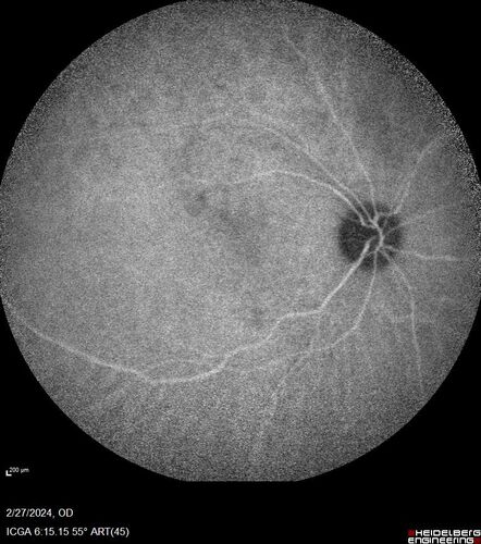 Syphilitic Chorioretinitis
41 year old man with vision loss for five days left eye.  VA 20/32, 20/200
