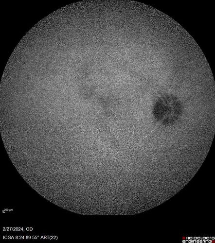 Syphilitic Chorioretinitis
41 year old man with vision loss for five days left eye.  VA 20/32, 20/200
