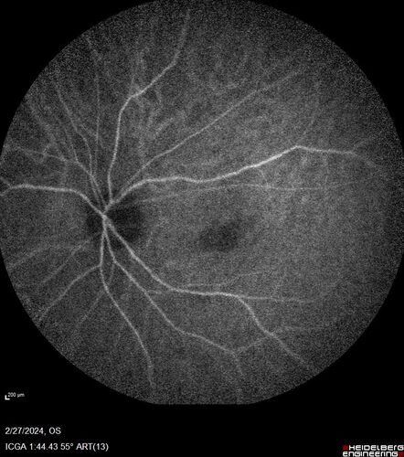 Syphilitic Chorioretinitis
41 year old man with vision loss for five days left eye.  VA 20/32, 20/200
