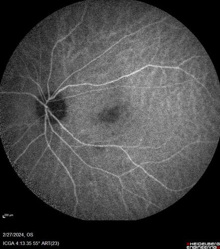 Syphilitic Chorioretinitis
41 year old man with vision loss for five days left eye.  VA 20/32, 20/200
