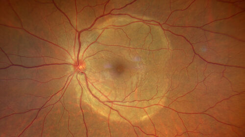 Acute Syphilitic Posterior Placoid Chorioretinitis
40 year old man About 10 days ago the patient woke up with a dark circle in the middle of the left eye that blocks his vision.Â  He thought it might be from fatigue.Â  The month of March was very stressful.Â  After a few days the spot in the left eye got darker and he could not drive at night.Â  During the last week while not going to work and sleeping more his vision is better but not normal.Â  He has never had vision loss in the past.Â Â 
PMHx: Benign,  Meds: Multivitamin
VA OD: sc20/16 NscJ1+VA OS: sc20/32+2 NscJ4
IOP: TP: OD:12 OS:12
