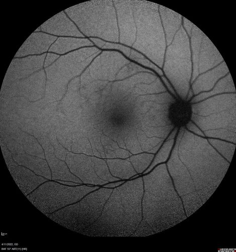 Acute Syphilitic Posterior Placoid Chorioretinitis
40 year old man About 10 days ago the patient woke up with a dark circle in the middle of the left eye that blocks his vision.Â  He thought it might be from fatigue.Â  The month of March was very stressful.Â  After a few days the spot in the left eye got darker and he could not drive at night.Â  During the last week while not going to work and sleeping more his vision is better but not normal.Â  He has never had vision loss in the past.Â Â 
PMHx: Benign,  Meds: Multivitamin
VA OD: sc20/16 NscJ1+VA OS: sc20/32+2 NscJ4
IOP: TP: OD:12 OS:12
