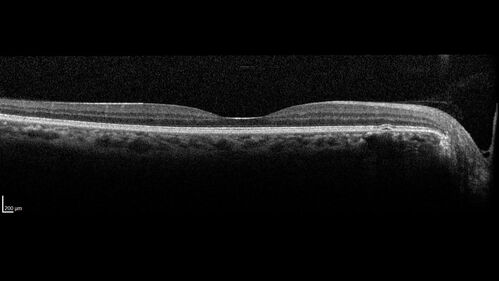 Acute Syphilitic Posterior Placoid Chorioretinitis
40 year old man About 10 days ago the patient woke up with a dark circle in the middle of the left eye that blocks his vision.Â  He thought it might be from fatigue.Â  The month of March was very stressful.Â  After a few days the spot in the left eye got darker and he could not drive at night.Â  During the last week while not going to work and sleeping more his vision is better but not normal.Â  He has never had vision loss in the past.Â Â 
PMHx: Benign,  Meds: Multivitamin
VA OD: sc20/16 NscJ1+VA OS: sc20/32+2 NscJ4
IOP: TP: OD:12 OS:12

