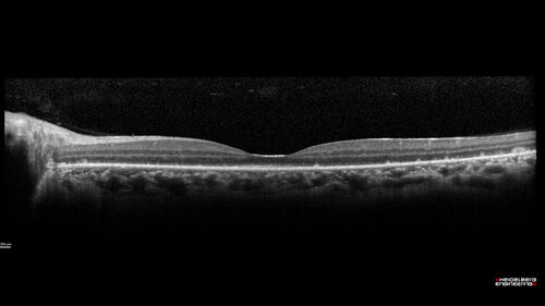 Acute Syphilitic Posterior Placoid Chorioretinitis
40 year old man About 10 days ago the patient woke up with a dark circle in the middle of the left eye that blocks his vision.Â  He thought it might be from fatigue.Â  The month of March was very stressful.Â  After a few days the spot in the left eye got darker and he could not drive at night.Â  During the last week while not going to work and sleeping more his vision is better but not normal.Â  He has never had vision loss in the past.Â Â 
PMHx: Benign,  Meds: Multivitamin
VA OD: sc20/16 NscJ1+VA OS: sc20/32+2 NscJ4
IOP: TP: OD:12 OS:12
