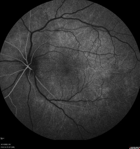 Acute Syphilitic Posterior Placoid Chorioretinitis
40 year old man About 10 days ago the patient woke up with a dark circle in the middle of the left eye that blocks his vision.Â  He thought it might be from fatigue.Â  The month of March was very stressful.Â  After a few days the spot in the left eye got darker and he could not drive at night.Â  During the last week while not going to work and sleeping more his vision is better but not normal.Â  He has never had vision loss in the past.Â Â 
PMHx: Benign,  Meds: Multivitamin
VA OD: sc20/16 NscJ1+VA OS: sc20/32+2 NscJ4
IOP: TP: OD:12 OS:12
