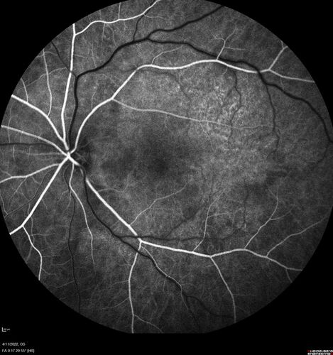 Acute Syphilitic Posterior Placoid Chorioretinitis
40 year old man About 10 days ago the patient woke up with a dark circle in the middle of the left eye that blocks his vision.Â  He thought it might be from fatigue.Â  The month of March was very stressful.Â  After a few days the spot in the left eye got darker and he could not drive at night.Â  During the last week while not going to work and sleeping more his vision is better but not normal.Â  He has never had vision loss in the past.Â Â 
PMHx: Benign,  Meds: Multivitamin
VA OD: sc20/16 NscJ1+VA OS: sc20/32+2 NscJ4
IOP: TP: OD:12 OS:12
