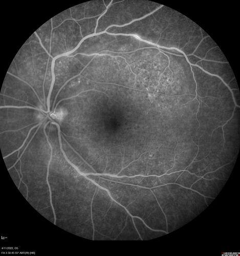 Acute Syphilitic Posterior Placoid Chorioretinitis
40 year old man About 10 days ago the patient woke up with a dark circle in the middle of the left eye that blocks his vision.Â  He thought it might be from fatigue.Â  The month of March was very stressful.Â  After a few days the spot in the left eye got darker and he could not drive at night.Â  During the last week while not going to work and sleeping more his vision is better but not normal.Â  He has never had vision loss in the past.Â Â 
PMHx: Benign,  Meds: Multivitamin
VA OD: sc20/16 NscJ1+VA OS: sc20/32+2 NscJ4
IOP: TP: OD:12 OS:12
