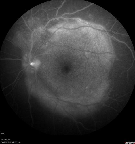 Acute Syphilitic Posterior Placoid Chorioretinitis
40 year old man About 10 days ago the patient woke up with a dark circle in the middle of the left eye that blocks his vision.Â  He thought it might be from fatigue.Â  The month of March was very stressful.Â  After a few days the spot in the left eye got darker and he could not drive at night.Â  During the last week while not going to work and sleeping more his vision is better but not normal.Â  He has never had vision loss in the past.Â Â 
PMHx: Benign,  Meds: Multivitamin
VA OD: sc20/16 NscJ1+VA OS: sc20/32+2 NscJ4
IOP: TP: OD:12 OS:12
