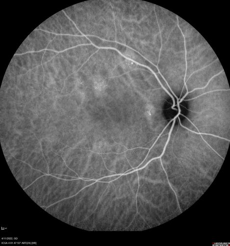 Acute Syphilitic Posterior Placoid Chorioretinitis
40 year old man About 10 days ago the patient woke up with a dark circle in the middle of the left eye that blocks his vision.Â  He thought it might be from fatigue.Â  The month of March was very stressful.Â  After a few days the spot in the left eye got darker and he could not drive at night.Â  During the last week while not going to work and sleeping more his vision is better but not normal.Â  He has never had vision loss in the past.Â Â 
PMHx: Benign,  Meds: Multivitamin
VA OD: sc20/16 NscJ1+VA OS: sc20/32+2 NscJ4
IOP: TP: OD:12 OS:12
