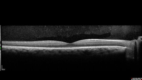 Syphilitic Chorioretinitis - 1 month post-treatment
41 year old man with vision loss for five days left eye.  VA 20/32, 20/200
