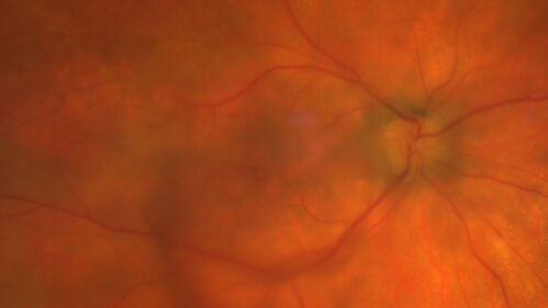 Severe Syphilitic Placoid Chorioretinitis
68 year old man 3 months ago the vision started fading in both eyes.  Just sitting here he can see some light out of his right eye. The patient denies any recent illness or travel.  
VA: OD: LP, OS: 4/200
IOP: 9, 13
Anterior segment: 1+ cell/ 2+ flare OU and 2+ NS and anterior vitreous cells
Labs Reactive RPR 1:256, FTA-ABS - reactive - Patient was admitted to hospital for IV PCN and recovered vision almost completely in the left eye and some in the right eye.
See line scans for recovery
