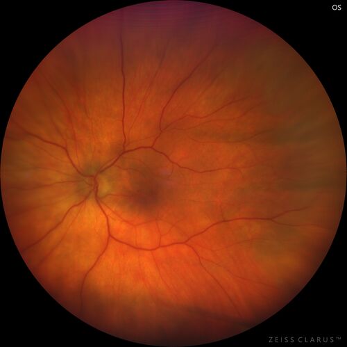 Severe Syphilitic Placoid Chorioretinitis
68 year old man 3 months ago the vision started fading in both eyes.  Just sitting here he can see some light out of his right eye. The patient denies any recent illness or travel.  
VA: OD: LP, OS: 4/200
IOP: 9, 13
Anterior segment: 1+ cell/ 2+ flare OU and 2+ NS and anterior vitreous cells
Labs Reactive RPR 1:256, FTA-ABS - reactive - Patient was admitted to hospital for IV PCN and recovered vision almost completely in the left eye and some in the right eye.
See line scans for recovery
