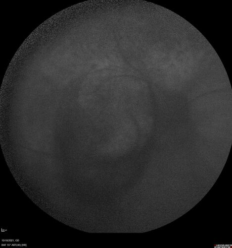 Severe Syphilitic Placoid Chorioretinitis
68 year old man 3 months ago the vision started fading in both eyes.  Just sitting here he can see some light out of his right eye. The patient denies any recent illness or travel.  
VA: OD: LP, OS: 4/200
IOP: 9, 13
Anterior segment: 1+ cell/ 2+ flare OU and 2+ NS and anterior vitreous cells
Labs Reactive RPR 1:256, FTA-ABS - reactive - Patient was admitted to hospital for IV PCN and recovered vision almost completely in the left eye and some in the right eye.
See line scans for recovery
