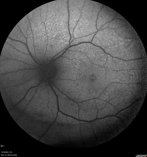 Severe Syphilitic Placoid Chorioretinitis
68 year old man 3 months ago the vision started fading in both eyes.  Just sitting here he can see some light out of his right eye. The patient denies any recent illness or travel.  
VA: OD: LP, OS: 4/200
IOP: 9, 13
Anterior segment: 1+ cell/ 2+ flare OU and 2+ NS and anterior vitreous cells
Labs Reactive RPR 1:256, FTA-ABS - reactive - Patient was admitted to hospital for IV PCN and recovered vision almost completely in the left eye and some in the right eye.
See line scans for recovery
