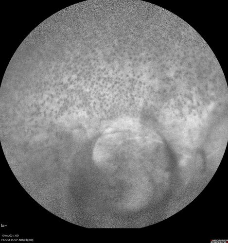 Severe Syphilitic Placoid Chorioretinitis
68 year old man 3 months ago the vision started fading in both eyes.  Just sitting here he can see some light out of his right eye. The patient denies any recent illness or travel.  
VA: OD: LP, OS: 4/200
IOP: 9, 13
Anterior segment: 1+ cell/ 2+ flare OU and 2+ NS and anterior vitreous cells
Labs Reactive RPR 1:256, FTA-ABS - reactive - Patient was admitted to hospital for IV PCN and recovered vision almost completely in the left eye and some in the right eye.
See line scans for recovery
