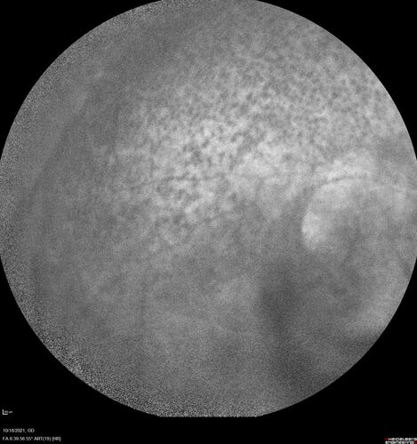 Severe Syphilitic Placoid Chorioretinitis
68 year old man 3 months ago the vision started fading in both eyes.  Just sitting here he can see some light out of his right eye. The patient denies any recent illness or travel.  
VA: OD: LP, OS: 4/200
IOP: 9, 13
Anterior segment: 1+ cell/ 2+ flare OU and 2+ NS and anterior vitreous cells
Labs Reactive RPR 1:256, FTA-ABS - reactive - Patient was admitted to hospital for IV PCN and recovered vision almost completely in the left eye and some in the right eye.
See line scans for recovery
