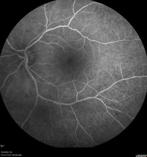 Severe Syphilitic Placoid Chorioretinitis
68 year old man 3 months ago the vision started fading in both eyes.  Just sitting here he can see some light out of his right eye. The patient denies any recent illness or travel.  
VA: OD: LP, OS: 4/200
IOP: 9, 13
Anterior segment: 1+ cell/ 2+ flare OU and 2+ NS and anterior vitreous cells
Labs Reactive RPR 1:256, FTA-ABS - reactive - Patient was admitted to hospital for IV PCN and recovered vision almost completely in the left eye and some in the right eye.
See line scans for recovery
