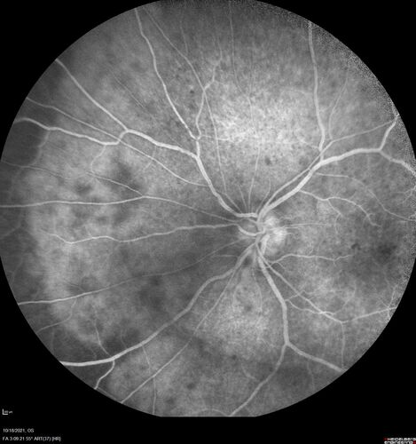 Severe Syphilitic Placoid Chorioretinitis
68 year old man 3 months ago the vision started fading in both eyes.  Just sitting here he can see some light out of his right eye. The patient denies any recent illness or travel.  
VA: OD: LP, OS: 4/200
IOP: 9, 13
Anterior segment: 1+ cell/ 2+ flare OU and 2+ NS and anterior vitreous cells
Labs Reactive RPR 1:256, FTA-ABS - reactive - Patient was admitted to hospital for IV PCN and recovered vision almost completely in the left eye and some in the right eye.
See line scans for recovery
