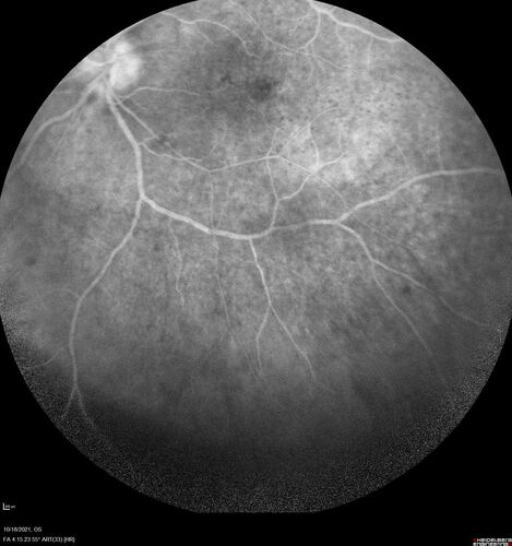 Severe Syphilitic Placoid Chorioretinitis
68 year old man 3 months ago the vision started fading in both eyes.  Just sitting here he can see some light out of his right eye. The patient denies any recent illness or travel.  
VA: OD: LP, OS: 4/200
IOP: 9, 13
Anterior segment: 1+ cell/ 2+ flare OU and 2+ NS and anterior vitreous cells
Labs Reactive RPR 1:256, FTA-ABS - reactive - Patient was admitted to hospital for IV PCN and recovered vision almost completely in the left eye and some in the right eye.
See line scans for recovery
