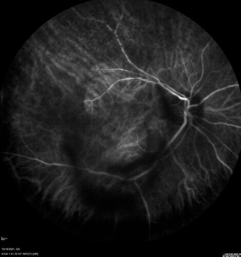 Severe Syphilitic Placoid Chorioretinitis
68 year old man 3 months ago the vision started fading in both eyes.  Just sitting here he can see some light out of his right eye. The patient denies any recent illness or travel.  
VA: OD: LP, OS: 4/200
IOP: 9, 13
Anterior segment: 1+ cell/ 2+ flare OU and 2+ NS and anterior vitreous cells
Labs Reactive RPR 1:256, FTA-ABS - reactive - Patient was admitted to hospital for IV PCN and recovered vision almost completely in the left eye and some in the right eye.
See line scans for recovery
