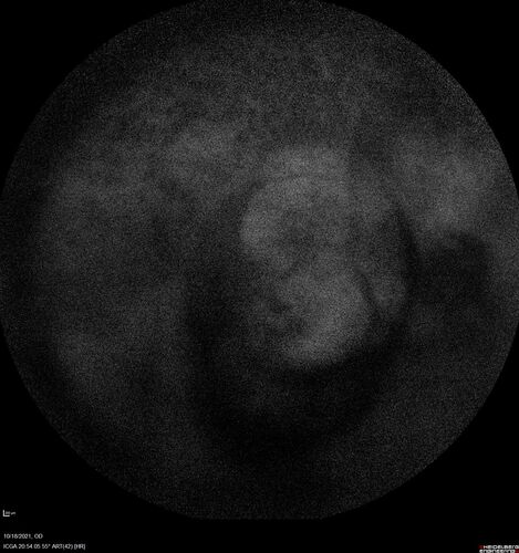 Severe Syphilitic Placoid Chorioretinitis
68 year old man 3 months ago the vision started fading in both eyes.  Just sitting here he can see some light out of his right eye. The patient denies any recent illness or travel.  
VA: OD: LP, OS: 4/200
IOP: 9, 13
Anterior segment: 1+ cell/ 2+ flare OU and 2+ NS and anterior vitreous cells
Labs Reactive RPR 1:256, FTA-ABS - reactive - Patient was admitted to hospital for IV PCN and recovered vision almost completely in the left eye and some in the right eye.
See line scans for recovery
