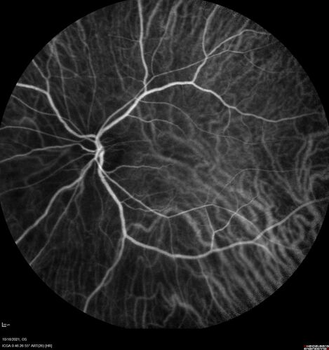 Severe Syphilitic Placoid Chorioretinitis
68 year old man 3 months ago the vision started fading in both eyes.  Just sitting here he can see some light out of his right eye. The patient denies any recent illness or travel.  
VA: OD: LP, OS: 4/200
IOP: 9, 13
Anterior segment: 1+ cell/ 2+ flare OU and 2+ NS and anterior vitreous cells
Labs Reactive RPR 1:256, FTA-ABS - reactive - Patient was admitted to hospital for IV PCN and recovered vision almost completely in the left eye and some in the right eye.
See line scans for recovery
