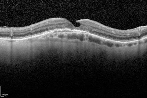 OCT shows lamellar macular hole left eye
Wet AMD in right and better eye failed extend to 2 months but was able to stop therapy once he started on systemic Avastin for cancer.  The last image shows the macula dry 9 months without local therapy.  The left eye has a lamellar macular hole.

