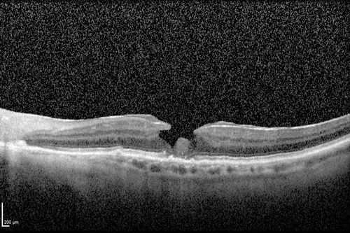 Wet AMD OD and Lamellar Macular hole OS
Wet AMD in right and better eye failed extend to 2 months but was able to stop therapy once he started on systemic Avastin for cancer.  The last image shows the macula dry 9 months without local therapy.  The left eye has a lamellar macular hole.
