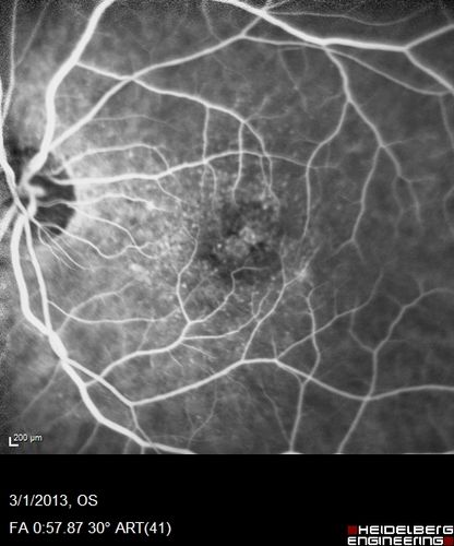 Wet AMD OD and Lamellar Macular hole OS
Wet AMD in right and better eye failed extend to 2 months but was able to stop therapy once he started on systemic Avastin for cancer.  The last image shows the macula dry 9 months without local therapy.  The left eye has a lamellar macular hole.
