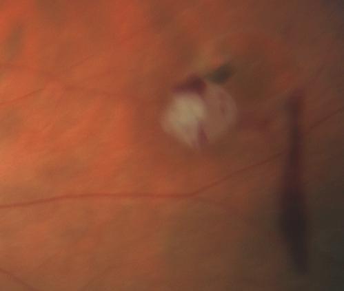 Operculated tear with fresh blood
