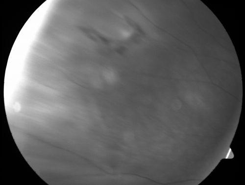 Retinal Flap Tear - Horseshoe - Cystic Retinal Tuft on Flap
73-year-old woman who noticed two days ago she was bending over and had a sudden â€œribbonâ€ in her 
vision which looked to her like blood.  VISUAL ACUITY:  Vision OD is 20/25, OS is 20/20.
