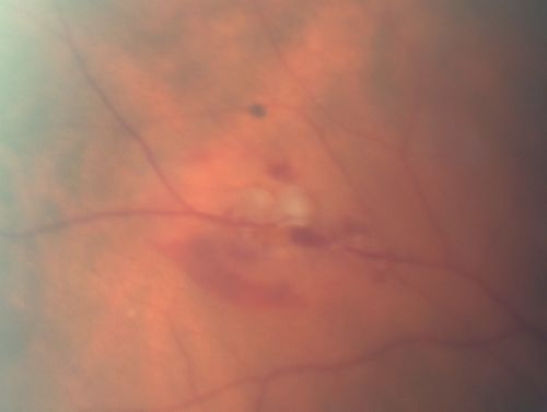 Retinal Tear with Vitreous Hemorrhage before and after Laser Photocoagulation
61-year-old man has noticed increased floaters in the right eye for about the last week.  Vision OD is 20/160 There is 3+ vitreous hemorrhage with a retinal tear, about 2-disc diameters posterior to the equator at 10:00 oâ€™clock over a retinal vessel.

