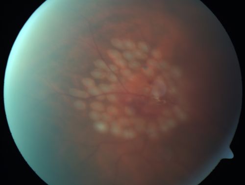 Retinal Tear with Vitreous Hemorrhage before and after Laser Photocoagulation
61-year-old man has noticed increased floaters in the right eye for about the last week.  Vision OD is 20/160 There is 3+ vitreous hemorrhage with a retinal tear, about 2-disc diameters posterior to the equator at 10:00 oâ€™clock over a retinal vessel.

