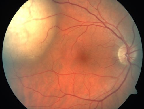 Choroidal Metastases - Both Eyes - Exudative Retinal Detachment
58-year-old man smoke a pack of cigarettes a day.  He has had some ribcage pain for about the last two weeks.  He also had a sinus infection for about two weeks, and he has also had hazy vision on the superior visual field in the left eye for about the last two weeks. vision is 20/25 in both eyes
