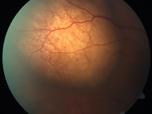 Choroidal Metastases - Both Eyes - Exudative Retinal Detachment
58-year-old man smoke a pack of cigarettes a day.  He has had some ribcage pain for about the last two weeks.  He also had a sinus infection for about two weeks, and he has also had hazy vision on the superior visual field in the left eye for about the last two weeks. vision is 20/25 in both eyes
