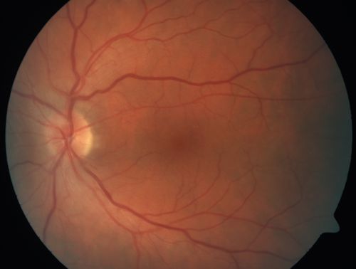 Choroidal Metastases - Both Eyes - Exudative Retinal Detachment
58-year-old man smoke a pack of cigarettes a day.  He has had some ribcage pain for about the last two weeks.  He also had a sinus infection for about two weeks, and he has also had hazy vision on the superior visual field in the left eye for about the last two weeks. vision is 20/25 in both eyes
