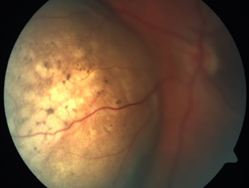 Choroidal Metastases - Both Eyes - Exudative Retinal Detachment
58-year-old man smoke a pack of cigarettes a day.  He has had some ribcage pain for about the last two weeks.  He also had a sinus infection for about two weeks, and he has also had hazy vision on the superior visual field in the left eye for about the last two weeks. vision is 20/25 in both eyes

