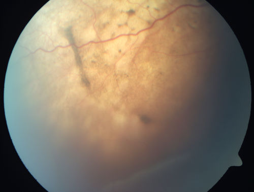 Choroidal Metastases - Both Eyes - Exudative Retinal Detachment
58-year-old man smoke a pack of cigarettes a day.  He has had some ribcage pain for about the last two weeks.  He also had a sinus infection for about two weeks, and he has also had hazy vision on the superior visual field in the left eye for about the last two weeks. vision is 20/25 in both eyes
