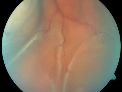 Choroidal Metastases - Both Eyes - Exudative Retinal Detachment
58-year-old man smoke a pack of cigarettes a day.  He has had some ribcage pain for about the last two weeks.  He also had a sinus infection for about two weeks, and he has also had hazy vision on the superior visual field in the left eye for about the last two weeks. vision is 20/25 in both eyes
