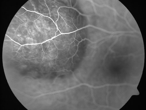 Choroidal Metastases - Both Eyes - Exudative Retinal Detachment
58-year-old man smoke a pack of cigarettes a day.  He has had some ribcage pain for about the last two weeks.  He also had a sinus infection for about two weeks, and he has also had hazy vision on the superior visual field in the left eye for about the last two weeks. vision is 20/25 in both eyes
